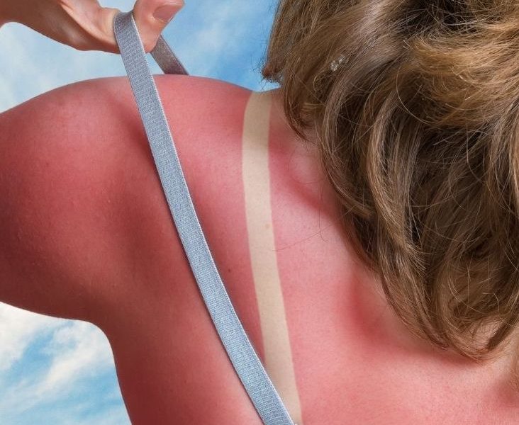 sunburn on woman's back