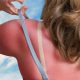 sunburn on woman's back