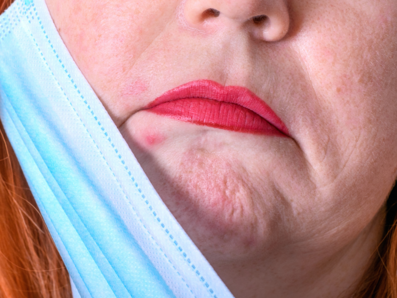 mascne or maskne on chin