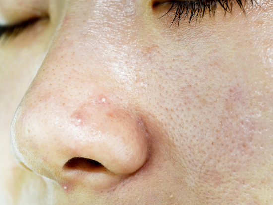 congested skin might need clear skin detox