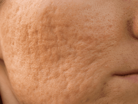 acne scarring