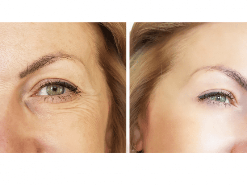 microneedling before and after