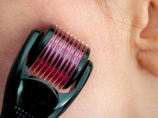 collagen induction therapy with derma roller
