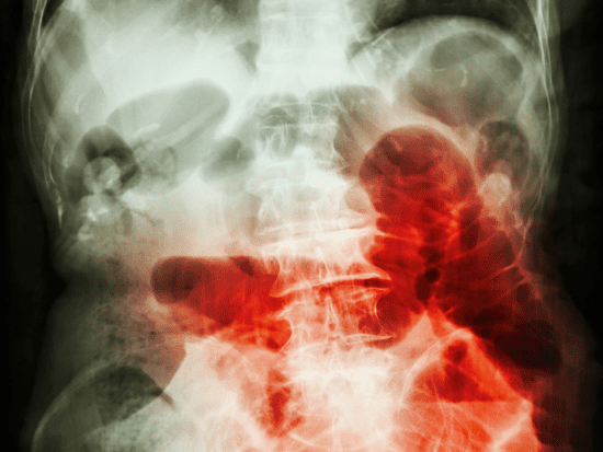 xray of twisted bowel